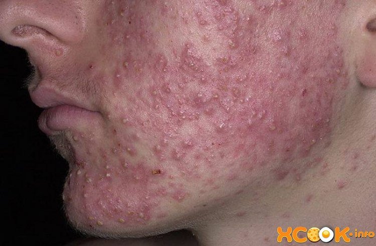 Вугрі (акне)   як позбутися косметологічними і народними засобами?