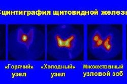 Наслідки видалення щитовидної залози у чоловіків