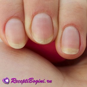 Чому шаруються нігті на руках: причини і що робити