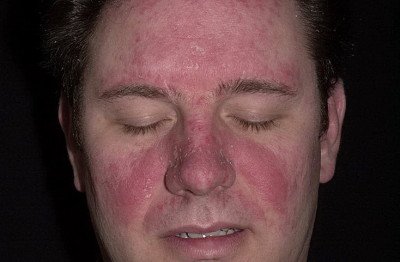 Жирна себорея на обличчі: лікування шкіри
