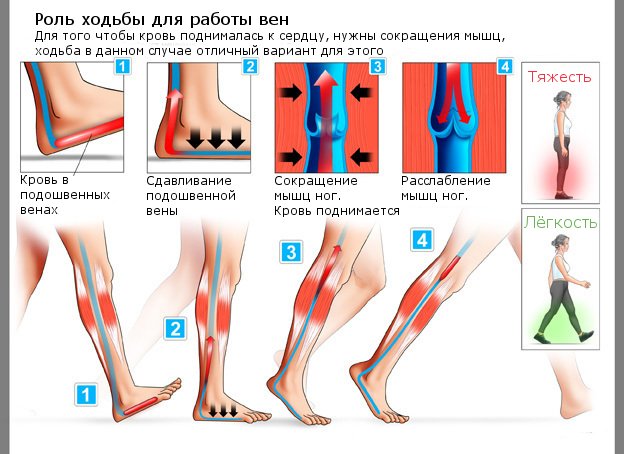 Потрібна ходьба при варикозі і яка користь від цього?