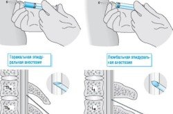 Епідуральна анестезія: техніка і побічні ефекти