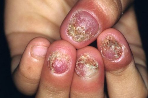Секрети ефективного лікування кандидозу на нігтях від кращих дерматологів