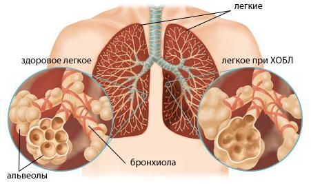 Лікування хронічної обструктивної хвороби легень