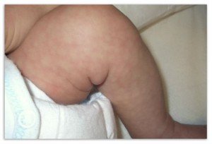 Мармурова шкіра вроджена телеангиэктатическая   причини, симптоми