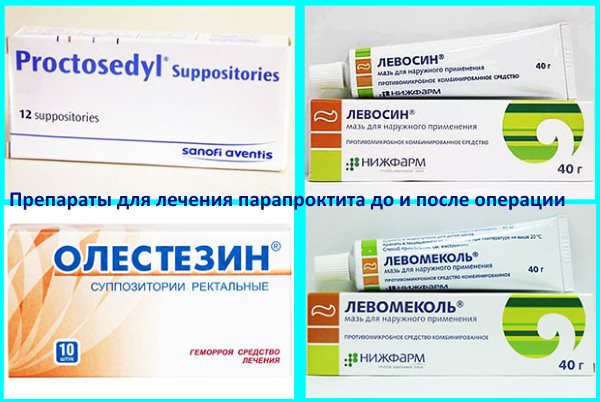 Лікування парапроктита ректальними суппотизориями