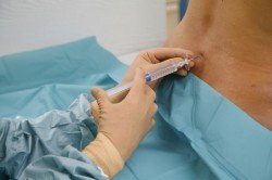 Епідуральна анестезія при пологах: показання та наслідки