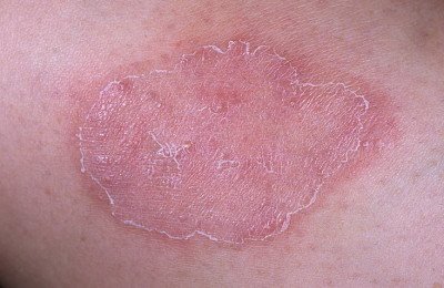 Грибкове захворювання мікоз шкіри: що це таке, симптоми, лікування, препарати