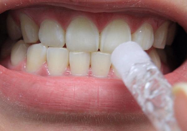 Як відбілити зуби в домашніх умовах швидко і ефективно?