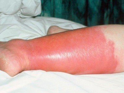 Бешихове запалення ноги: симптоми і лікування в домашніх умовах, антибіотики, мазі
