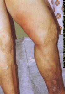 Тромбофлебіт на ногах: симптоми і лікування