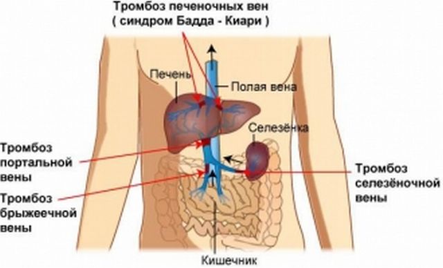 Причини, симптоми і лікування тромбозу ворітної вени печінки