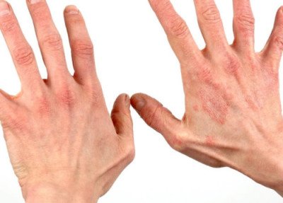 Зявляються червоні плями на руках (пальцях) сверблять і лущаться, що робити?