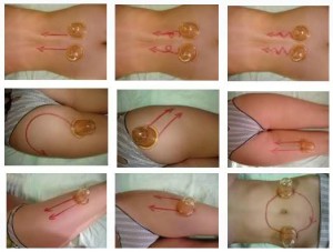 Антицелюлітний баночний масаж, ручний, апаратний (показання, техніка, тривалість, відгуки, відео)