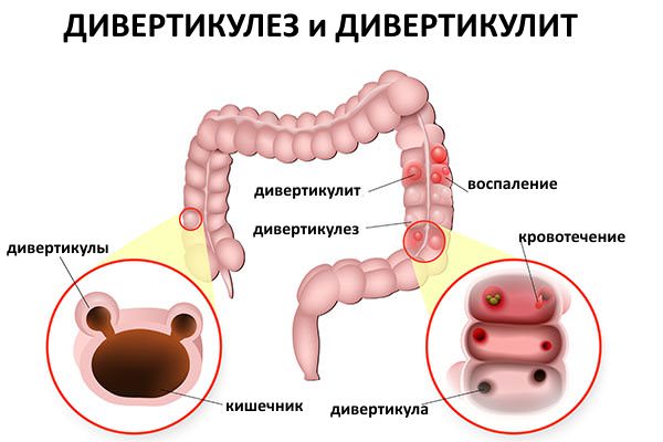 Симптоматика та лікування дивертикулеза