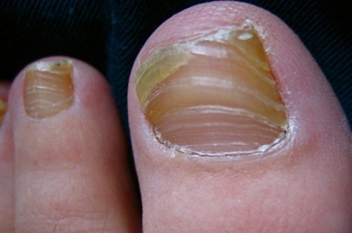 Секрети ефективного лікування кандидозу на нігтях від кращих дерматологів