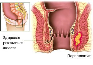 Симптоматика, види та лікування парапроктита
