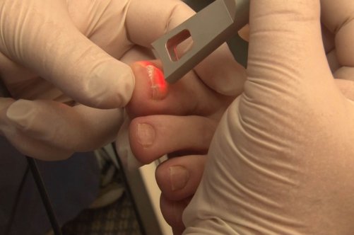 Види грибкових захворювань нігтів і їх лікування