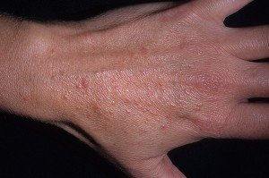 Фототоксическая реакція шкіри   причини, діагностика, лікування