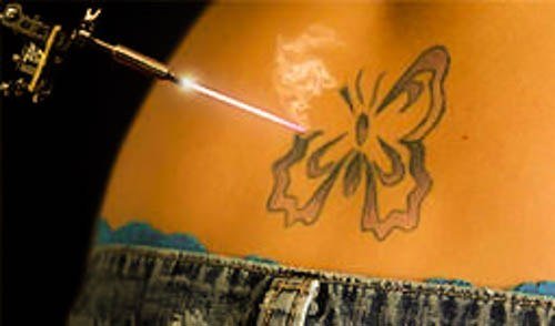 Видалення татуювань   лазером і іншими способами; виведення тату в домашніх умовах