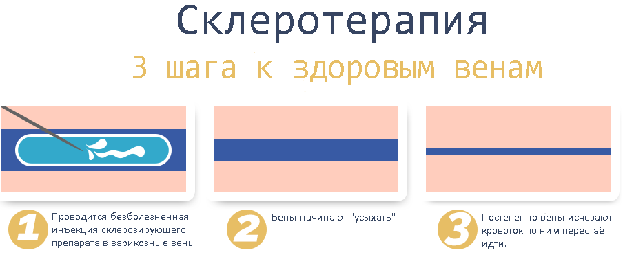 Склерозування вен нижніх кінцівок: для чого це потрібно?