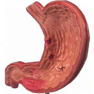 Дуодено гастральный рефлюкс шлунка (ДГР, гастродуоденальный): що це, симптоми, лікування