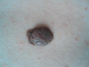 Чому свербить родимка, з яких причин?