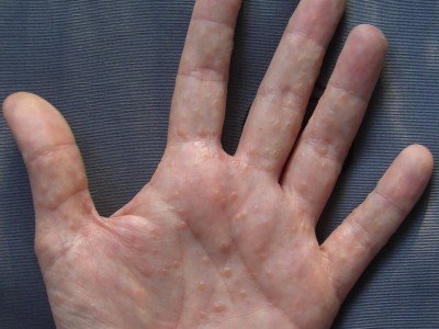 Як лікувати водянисті пухирці, пухирі на руках та долонях, зявляються пупиришки
