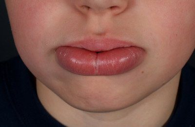 Лікування хейліту на губах (червона облямівка): що це таке