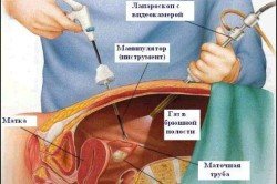 Операція на кишечнику: реабілітація та наслідки