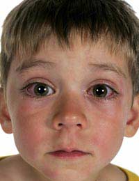 Червоне пляма в оці дитини і дорослого: лікування та профілактика