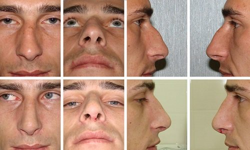 Операції на ніс: показання та протипоказання, відкрита, закрита і повторна ринопластика