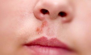 Висип навколо рота: Причини та Лікування висипу