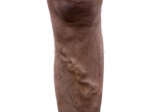 Варикоз на ногах: способи лікування