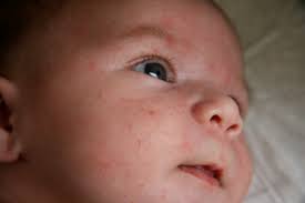 Чому зявляється висип на обличчі у дитини 1 місяць? Дрібна, алергічна висипка