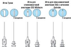 Епідуральна анестезія: техніка і побічні ефекти