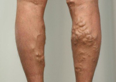 Сверблять, сверблять ноги нижче колін (гомілки, ікри): причини, лікування