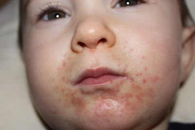Висип і роздратування навколо рота у дитини: причини червоних плям