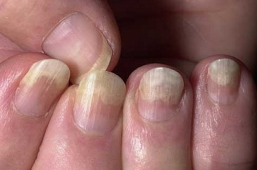 Як правильно і ефективно лікувати грибок нігтів на руках?