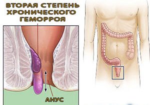 Як допомогти хворому в стадії загострення геморою?