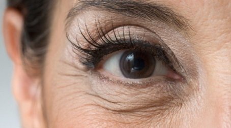 Зморшки навколо очей або гусячі лапки   їх причини; профілактика і боротьба з ними
