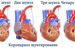 Операція на серці: шунтування