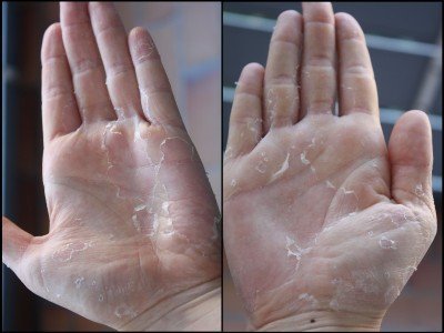Лущаться долоні, облазить шкіра на пальцях рук: чому тріскається і сохне?