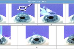 Операція Ласіков (LASIK) на очі: до та післяопераційний період (відео)