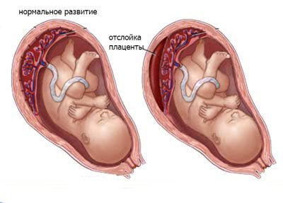 Тягнуть болі внизу живота (ліворуч, праворуч) при вагітності