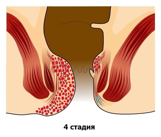 Як лікувати тромбоз зовнішнього гемороїдального вузла