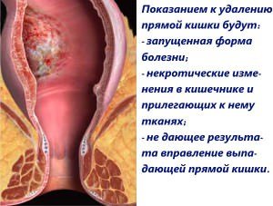 Як проводять операцію з видалення прямої кишки