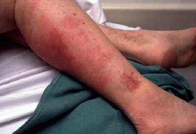 Пика на нозі: лікування захворювання, причини хвороби, заразним для оточуючих?