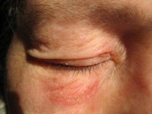 Червоні плями під очима у дорослих і дітей: причини, лікування