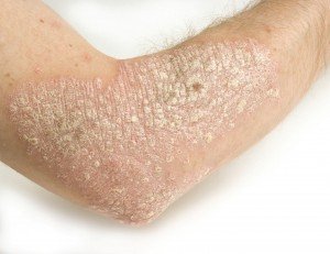 Лущення шкіри на ліктях: причини і лікування